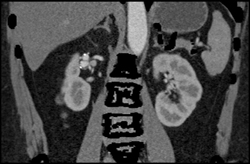 Renal Artery Aneurysm - CTisus CT Scan