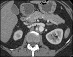 Left Renal Artery Aneurysm - CTisus CT Scan