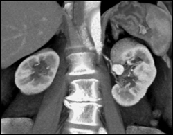 Fibromuscular Dysplasia on the Right and Renal Artery Aneurysm on the Left - CTisus CT Scan