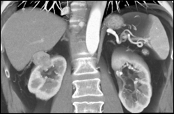 Hemangiopericytoma of the Kidney Simulates A Renal Cell - CTisus CT Scan