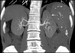 Normal Renal Arteries - CTisus CT Scan