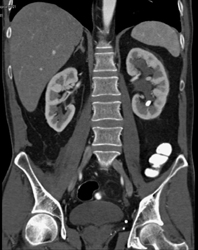 Dilated Left Renal Pelvis With Stone - CTisus CT Scan