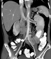 Partial Left Renal Vein Thrombosis - CTisus CT Scan