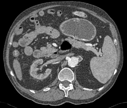 Left Renal Artery Aneurysm - CTisus CT Scan