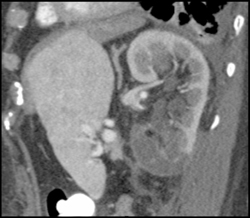 Renal Infarction-S/P Aneurysm Repair - CTisus CT Scan