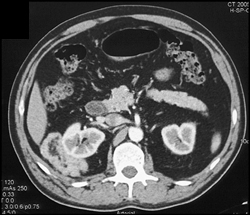 Renal Angiomyolipoma (AML) - CTisus CT Scan
