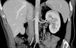 Collaterals in Left Renal Hilum - CTisus CT Scan