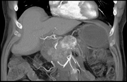 Metastatic Renal Cell Carcinoma to the Pancreas - CTisus CT Scan