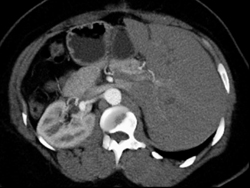 Renal Artery Aneurysm - CTisus CT Scan