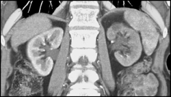 Delayed Function of Left Kidney Due to Renal Artery Stenosis - CTisus CT Scan