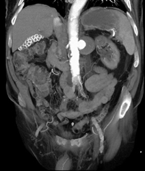 Large Renal Artery Aneurysm - CTisus CT Scan