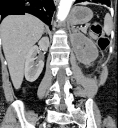 Renal Infarction - CTisus CT Scan