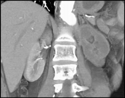 Renal Infarction - CTisus CT Scan