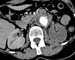 Renal Infarction - CTisus CT Scan