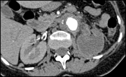 Renal Infarction - CTisus CT Scan