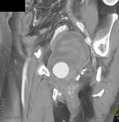 Internal Pudendal Artery Aneurysm - CTisus CT Scan