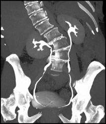 Ct Urogram With Elevated Base of Bladder - CTisus CT Scan