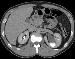 Para-pelvic Cysts in the Left Kidney - CTisus CT Scan