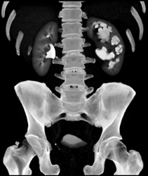 Dilated Left Renal Pelvis - CTisus CT Scan