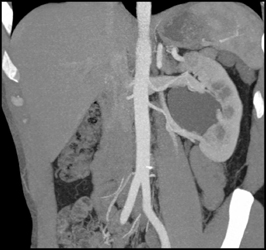 Ureteropelvic Junction (UPJ) Due to Renal Artery - CTisus CT Scan