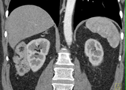 Renal Angiomyolipoma (AML) - CTisus CT Scan