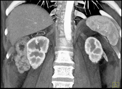 Renal Angiomyolipoma (AML) - CTisus CT Scan