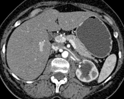 Retroperitoneal Fibrosis - CTisus CT Scan