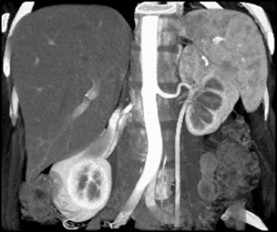 Retroperitoneal Fibrosis - CTisus CT Scan