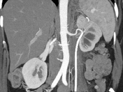 Retroperitoneal Fibrosis - CTisus CT Scan