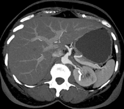 Retroperitoneal Fibrosis - CTisus CT Scan