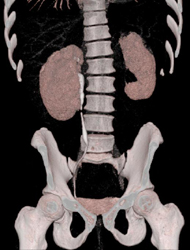 Delayed Function of Left Kidney - CTisus CT Scan