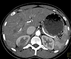 Acute Pyelonephritis - CTisus CT Scan