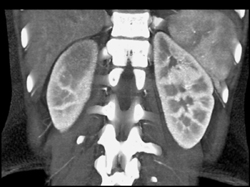 Acute Pyelonephritis - CTisus CT Scan