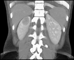 Acute Pyelonephritis - CTisus CT Scan