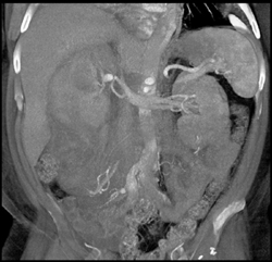 Bleed in Right Renal Bed - CTisus CT Scan