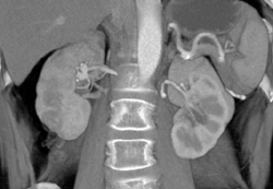 Renal Artery Aneurysm - CTisus CT Scan