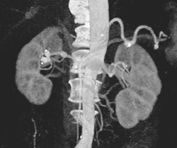 Renal Artery Aneurysm - Kidney Case Studies - CTisus CT Scanning