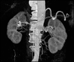 Renal Artery Aneurysm - CTisus CT Scan