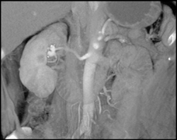 Renal Artery Aneurysm - CTisus CT Scan