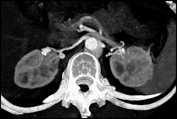 Renal Artery Aneurysm - CTisus CT Scan