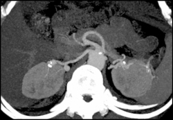 Renal Artery Aneurysm - CTisus CT Scan