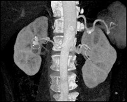 Renal Artery Aneurysm - CTisus CT Scan