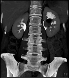 Renal Cyst Displaces the Calyces - CTisus CT Scan