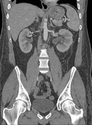 Chronic Renal Vein Thrombosis in Left Kidney - CTisus CT Scan