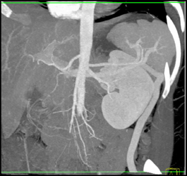 Collaterals Near the Kidney - CTisus CT Scan