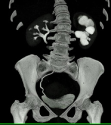 Dilated Calyces in Left Kidney - CTisus CT Scan