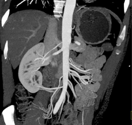 Three Right Renal Arteries - CTisus CT Scan