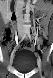 Collaterals Near Left Kidney and Prominent Gonadal Vein - CTisus CT Scan