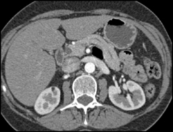 8 Mm Right Renal Angiomyolipoma (AML) - CTisus CT Scan