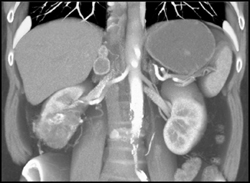 Transitional Cell Cancer (TCC) With Cystic Nodes - CTisus CT Scan